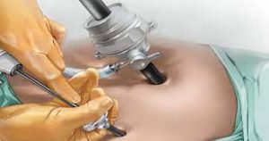 Laparoscopy Treatment in Nepal